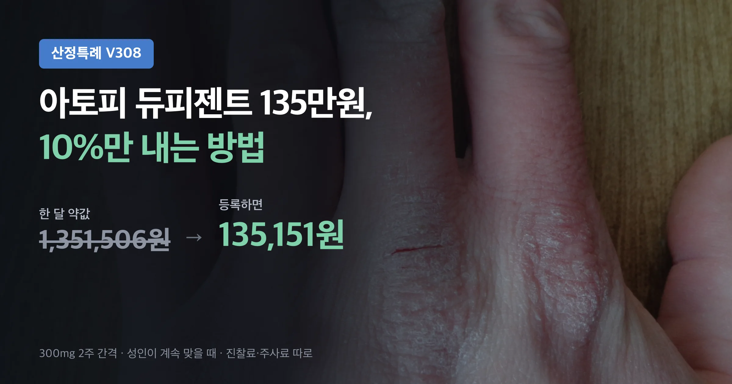 듀피젠트 한 달 약값 1,351,506원이 산정특례 등록으로 135,151원이 된다는 요약 이미지