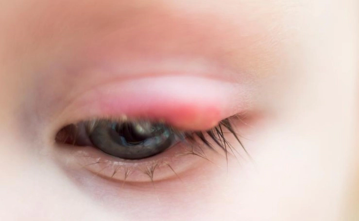 다래끼 초기증상 7가지