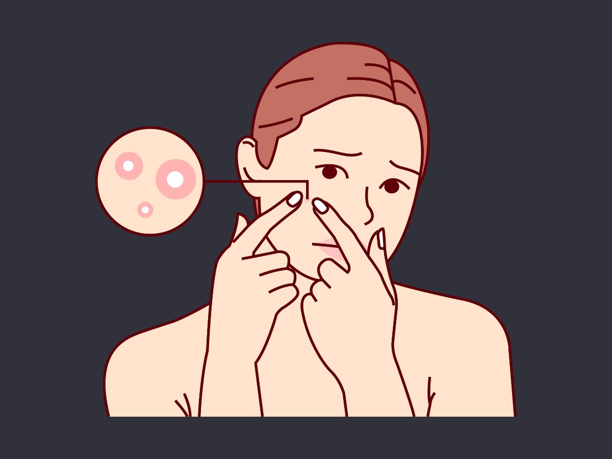 애크논 크림 사용법