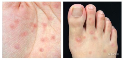 수족구_손발_수포