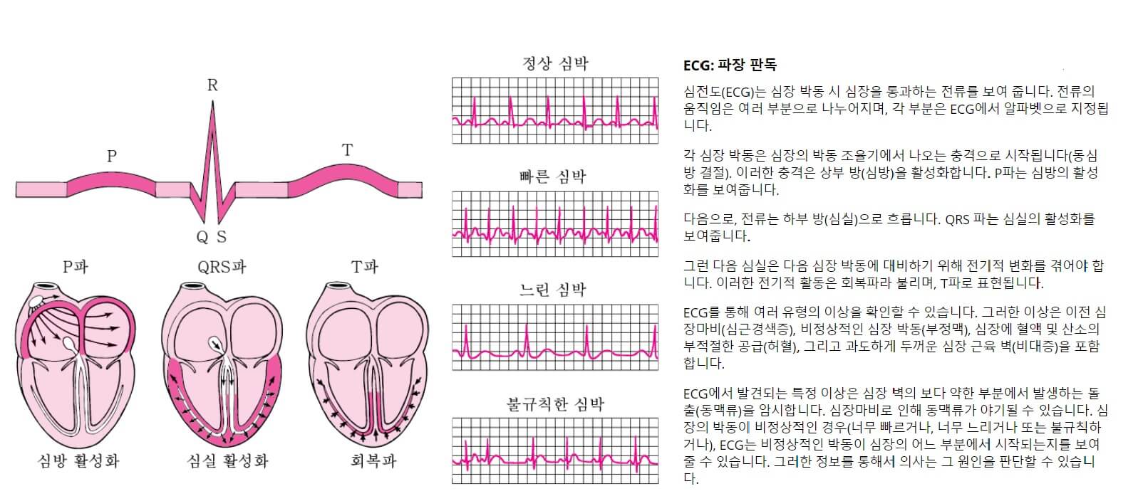 ECG 파장 판동