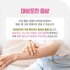 대상포진6
