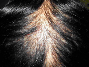 탈모 흉터가 있는 두피