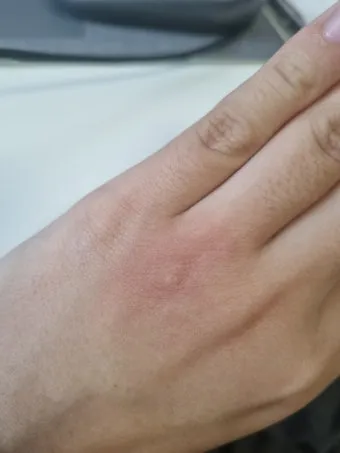 모기 물려 가려울 때 땀띠에 안티푸라민 연고 효능 부작용 사용후기_18