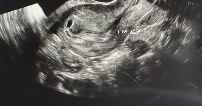 첫-초음파-사진