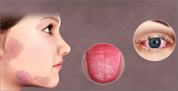 쇼그렌증후군의 대표증상 입과 눈이 건조함을 표현한사진