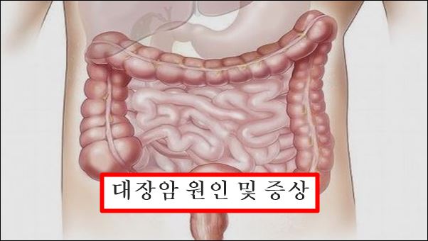대장암의 증상