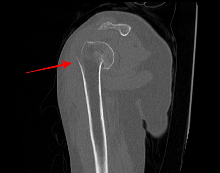 humerus sagittal image