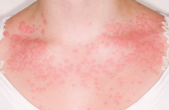 콜린성 두드러기 증상