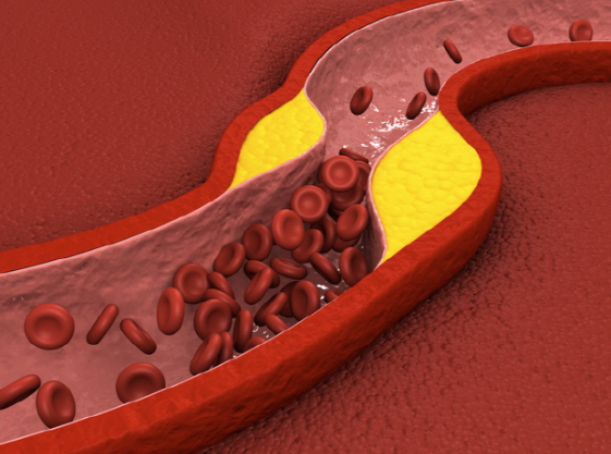 LDL 콜레스테롤 낮추는 법