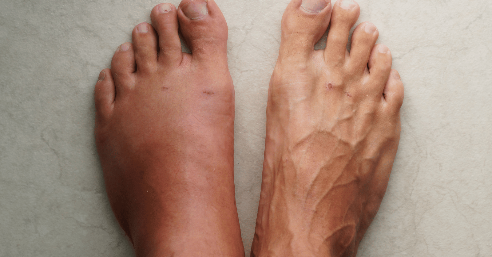 진드기물린후증상