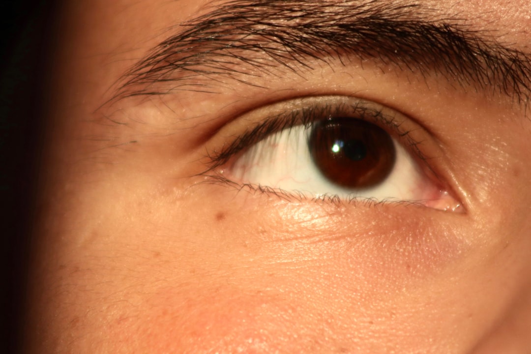 Hyperpigmentation