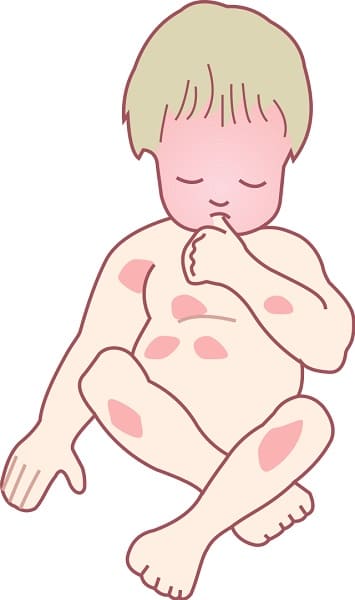 성인기 아토피 증상 사진