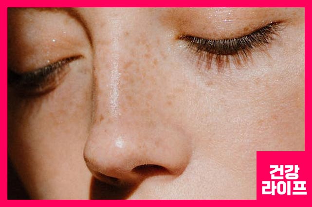 기미 없애는 방법