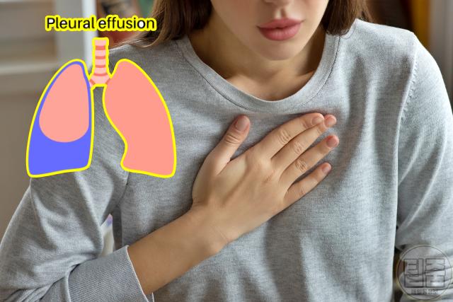 난소암 증상 전조증상 호흡기 천식