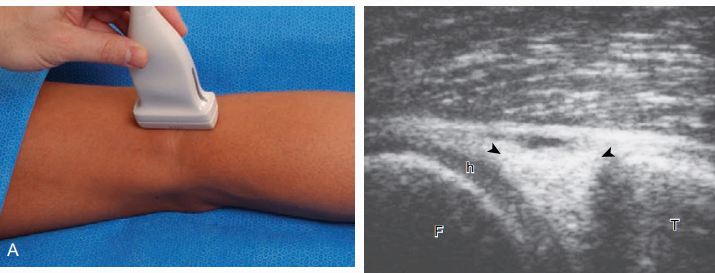 무릎 뒤쪽 검사