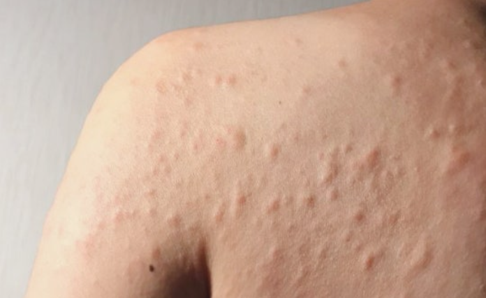 아나필락시스의 증상