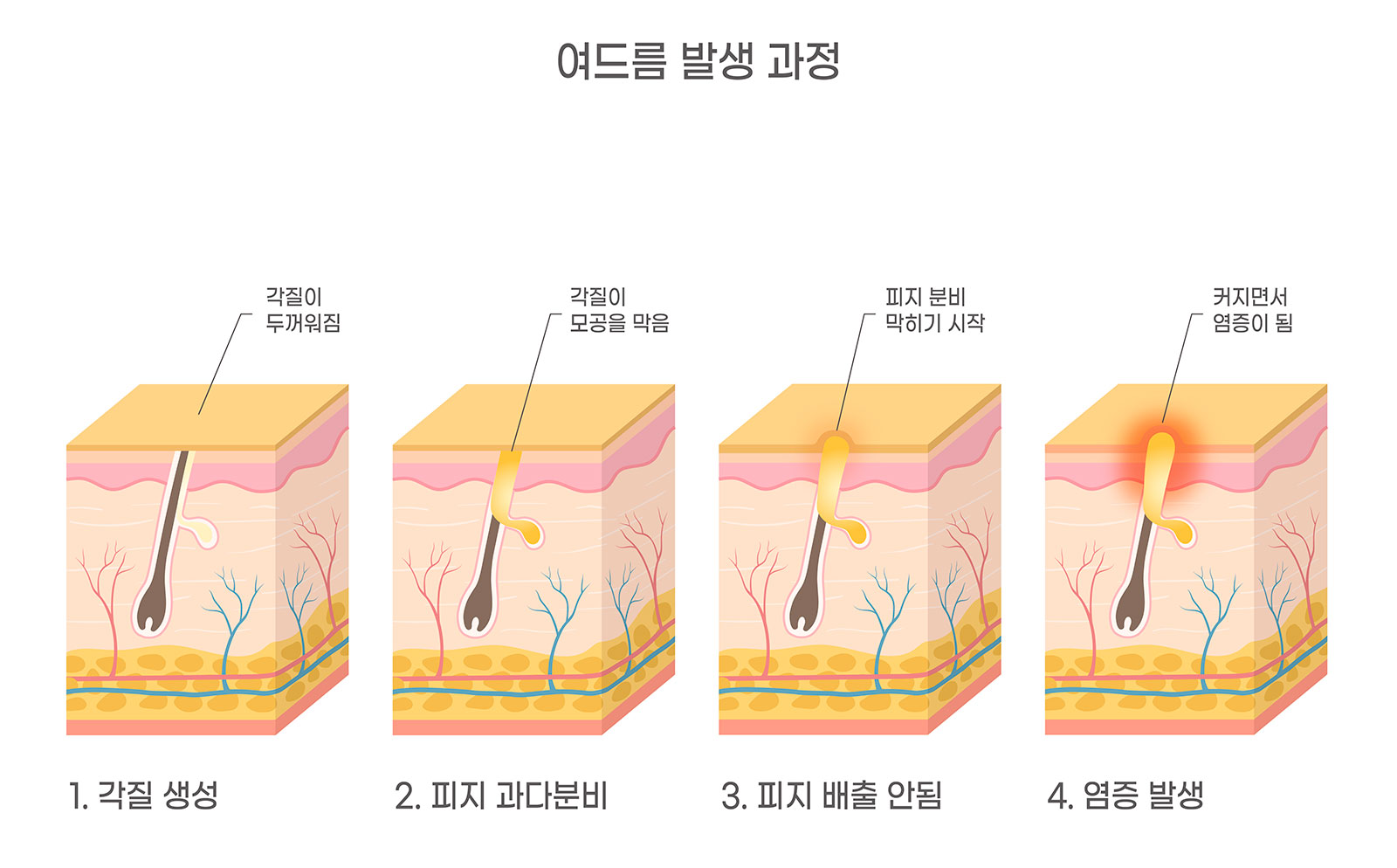 여드름 없애기