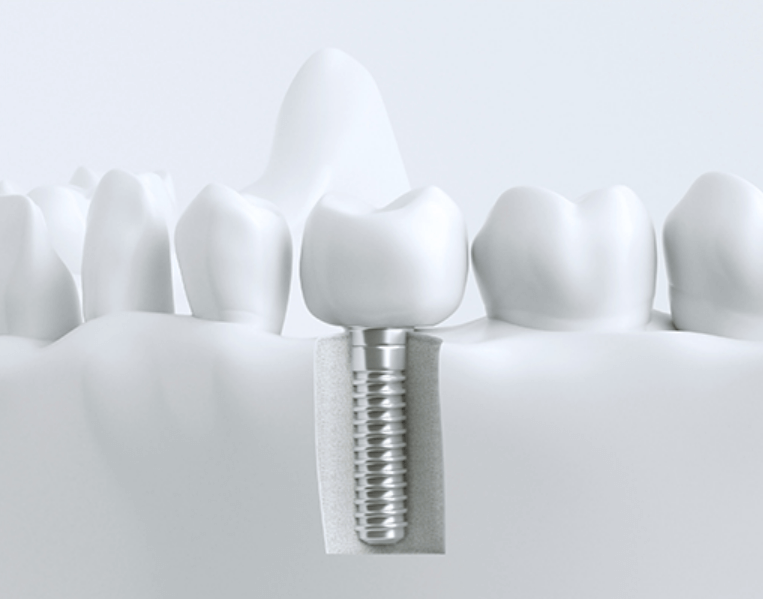 봉담임플란트치과추천-봉담임플란트잘하는곳