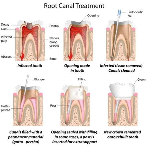 재신경치료-실패