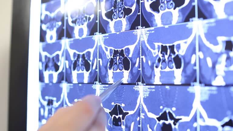 성장기 아데노이드형 얼굴 교정, 언제 시작해야 할까?