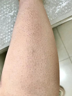 비판텐 가격은? 문제성 피부 조직 회복과 보습 효과를 가진 연고라 상비약으로 두기 딱 좋은 듯