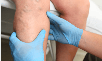 하지 정맥류 증상 수술비용