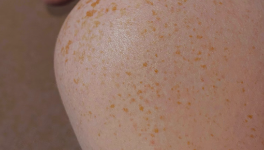 아르기닌 효능 : 피부 건강