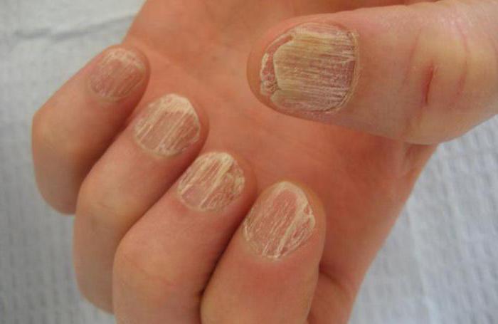 손톱 조갑 박리증