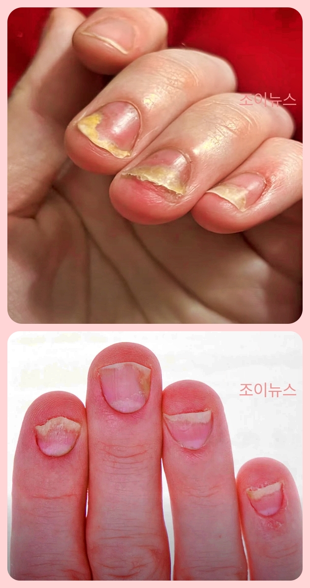 울퉁불퉁한 손톱, 원인과 관리법은?