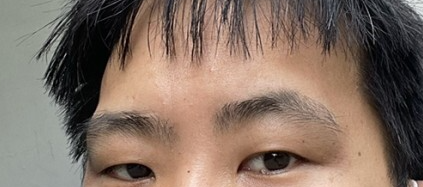 측두근 보톡스