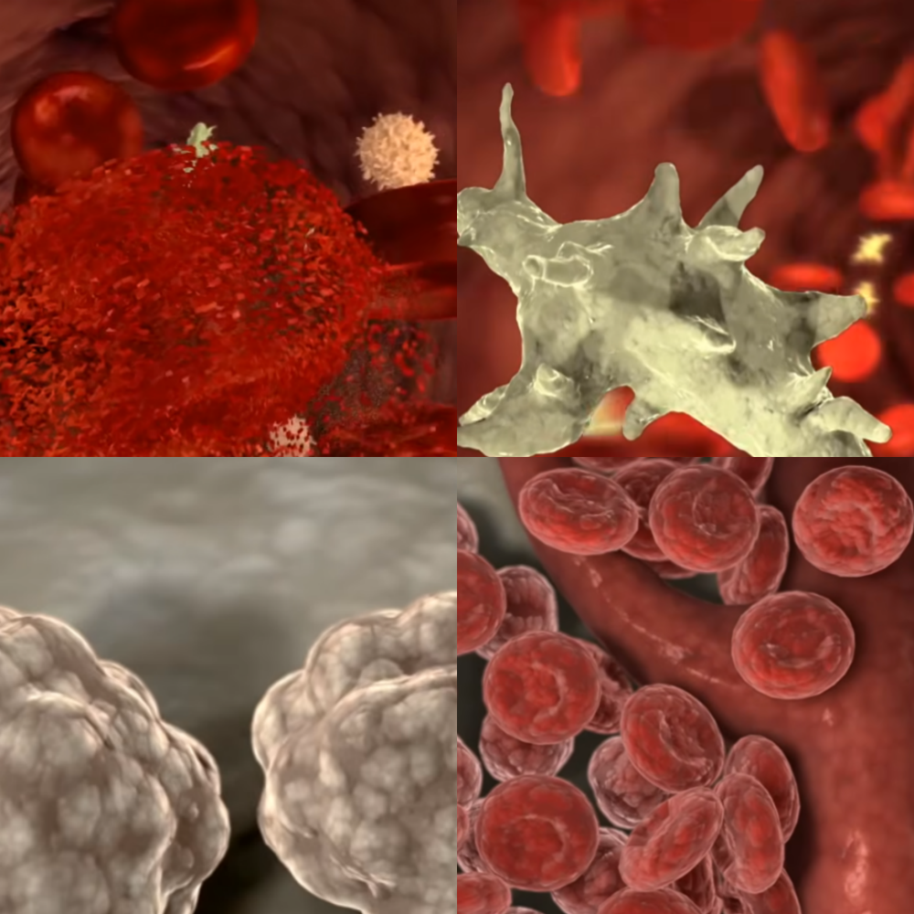 혈액암 초기증상