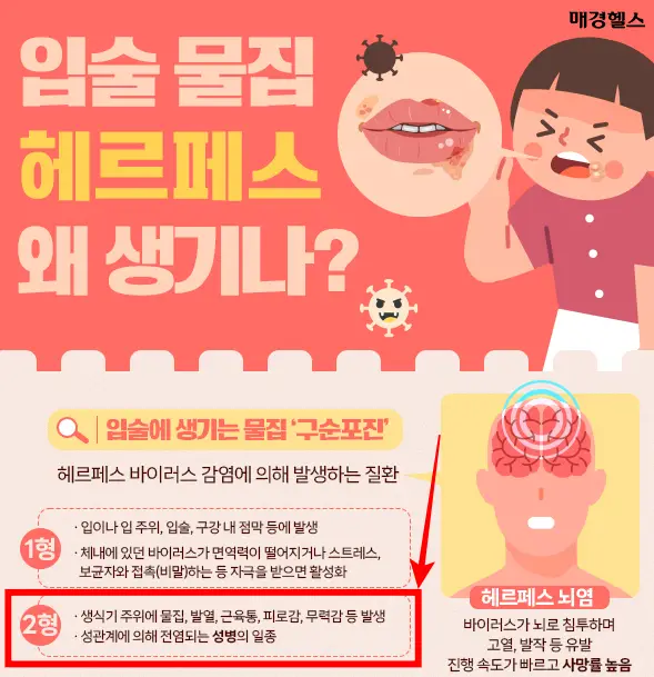 헤르페스-1형-2형-질환