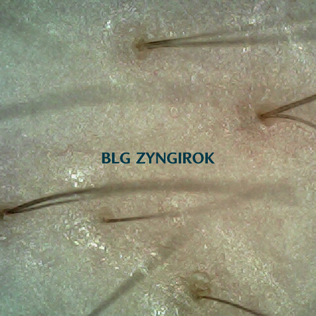 탈모 극복 프로젝트 - 오른쪽 M자 부위 두피 모습이다.