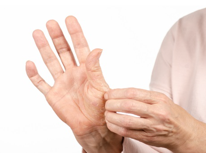 주부습진의 원인