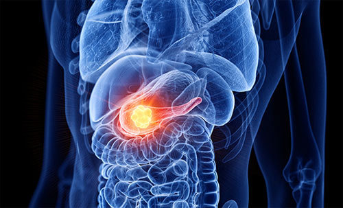 췌장이 안좋으면 나타나는 증상 10가지