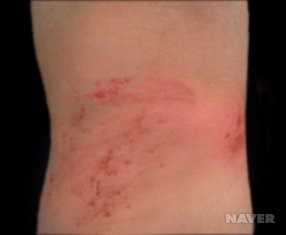 아토피 피부염 원인과 증상&amp;#44; 치료법 