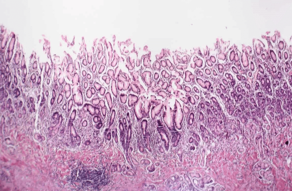 위염-자료-모습