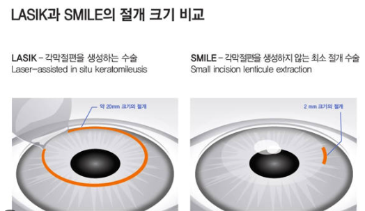 스마일라식 후기