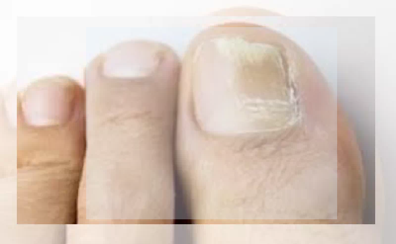 엄지발톱 노란색 변색