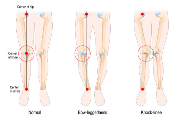 정상무릎정렬과 엑스다리 오다리 구조