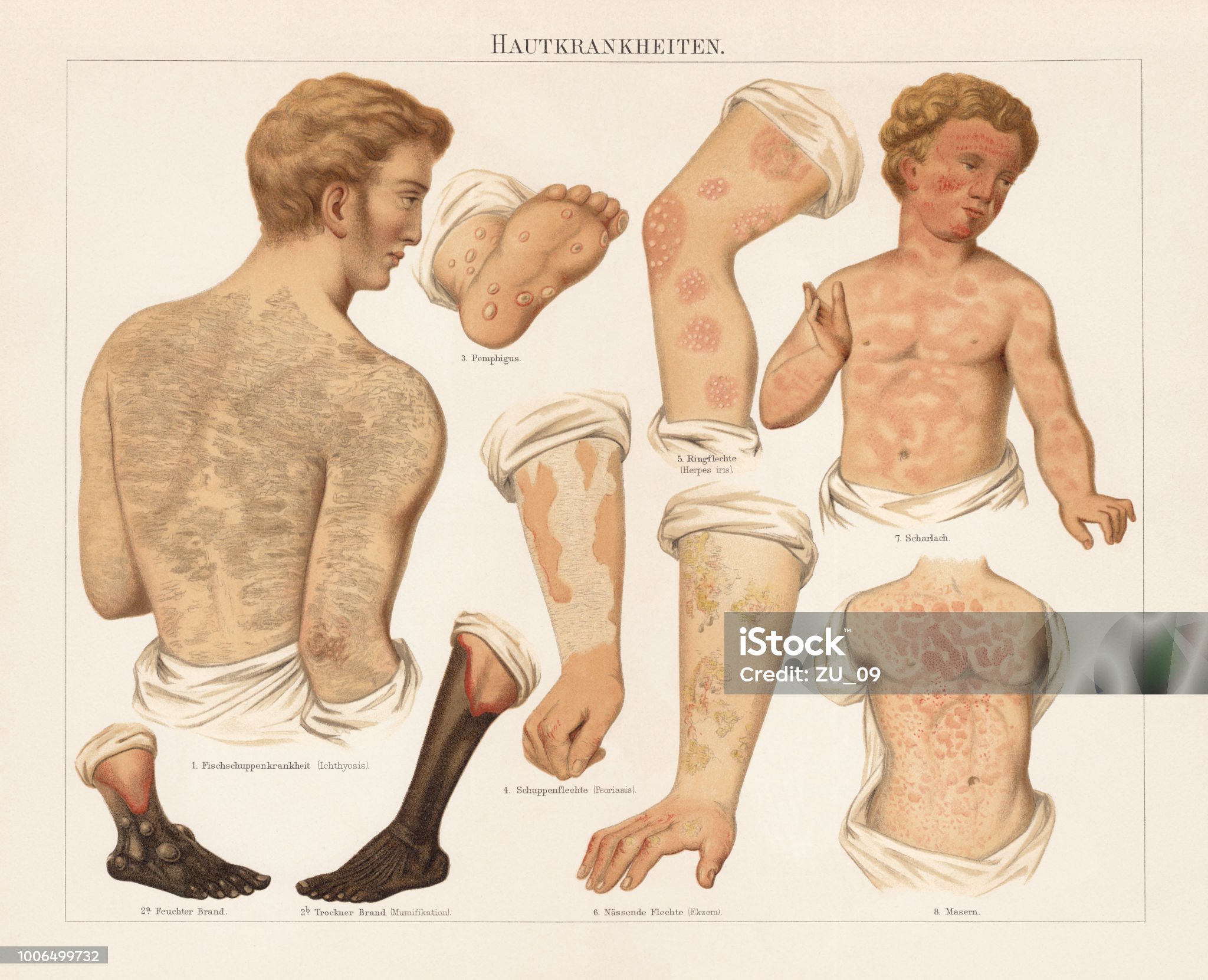 성홍열-관련-사진