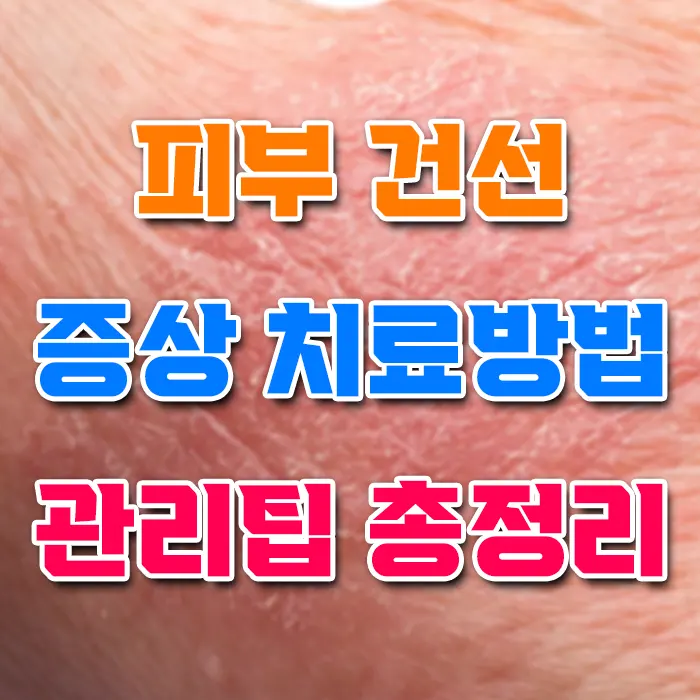 피부 건선 증상 치료방법 관리팁 총정리