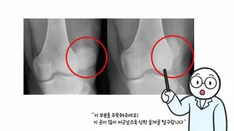 강아지 슬개골 탈구 수술 후유증_5