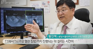 췌장암명의