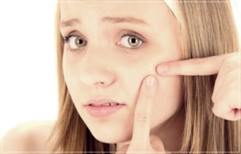 결절성 여드름 관리 잘하는 방법 3가지