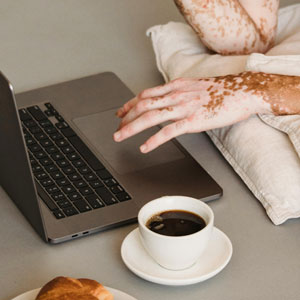 백반증 초기증상 - 흰색 반점