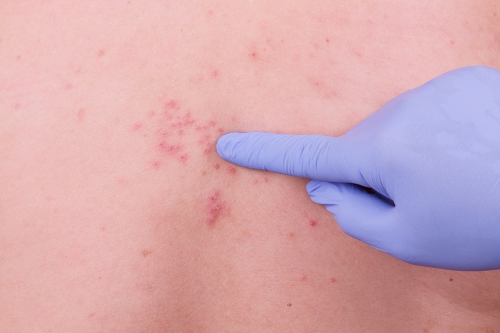 대상포진의 증상과 치료법&#44; 대상포진에 좋은 음식