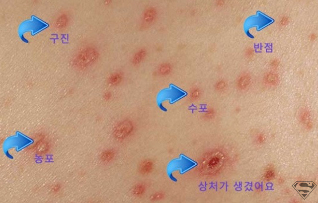수족구와 수두의 차이점