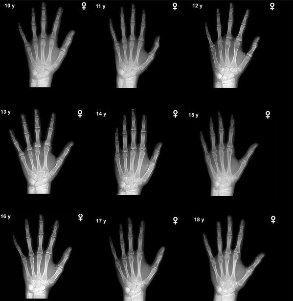 우리 아이 키 성장, 지금 확인하세요 – 성장판 검사 시기·비용 완전 가이드 관련 사진